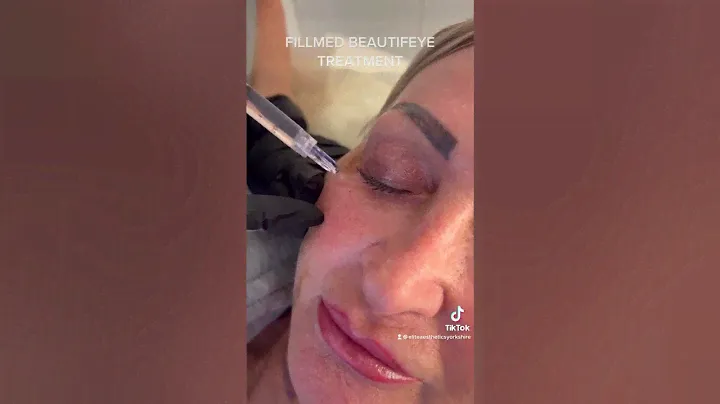 FILLMED Beautifeye treatment