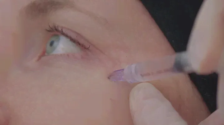 FILLMED Nanosoft Microneedles by Filorga