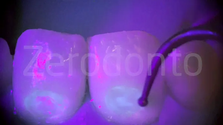 New light source for composite material | Zerodonto | Zerodonto