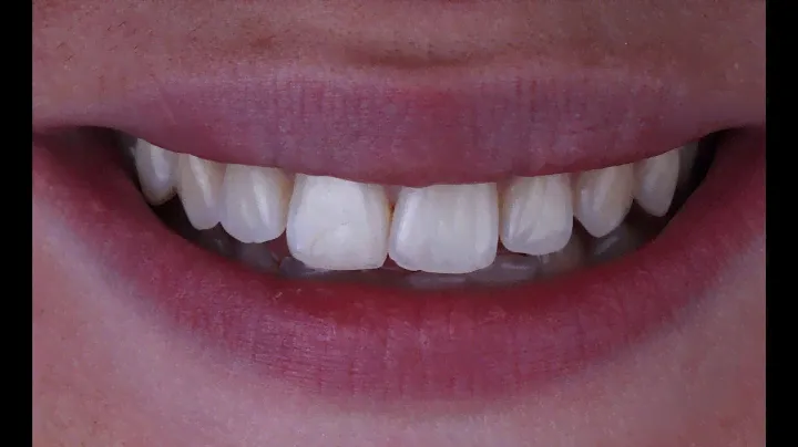 Flashes for Dental Photography