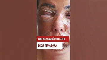 Феноловый пилинг. Вся правда о процедуре!